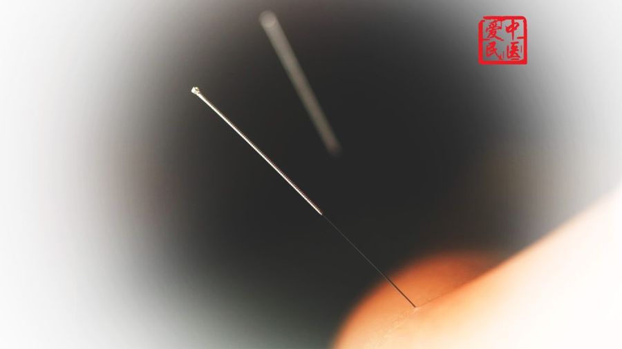 在Aimin TCM Clinic进行的施氏减肥针灸治疗